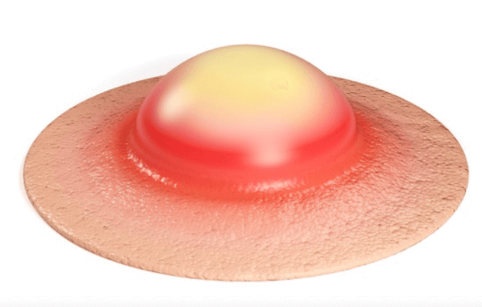 여자 사타구니 질환에 대해 알아보자