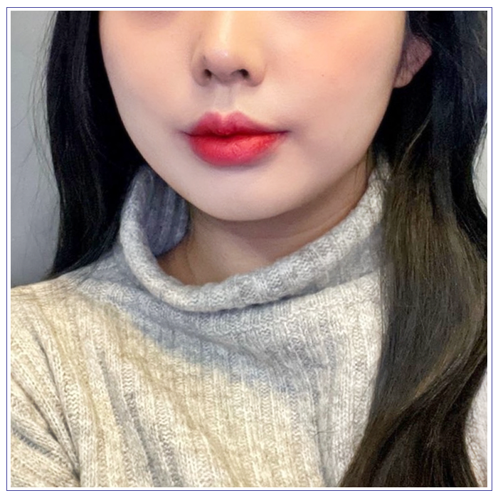 윤곽주사 후기