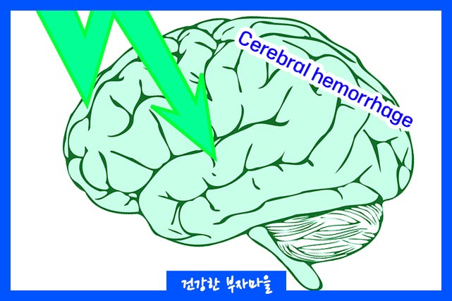 뇌출혈 후유증