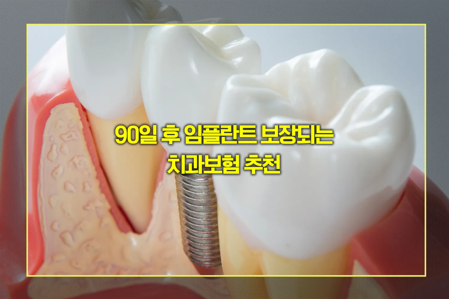 치아보험-임플란트-90일보장-실버플랜-가입요령
