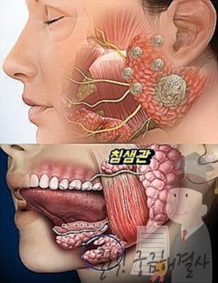 턱 밑 멍울