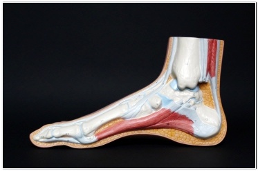 무지 외반증 치료법