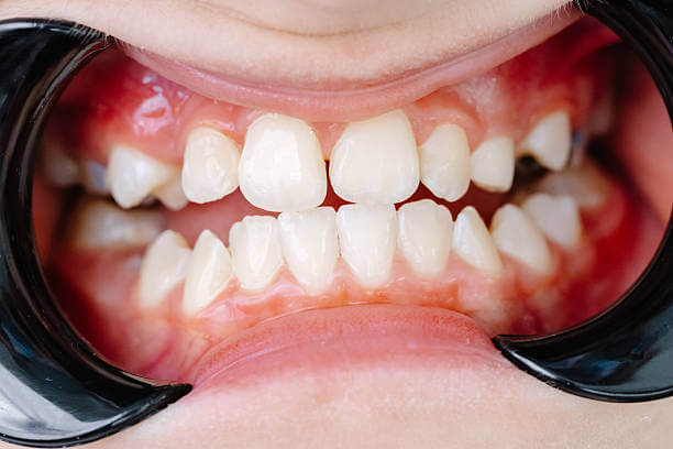 턱교정 비용 주요 요인