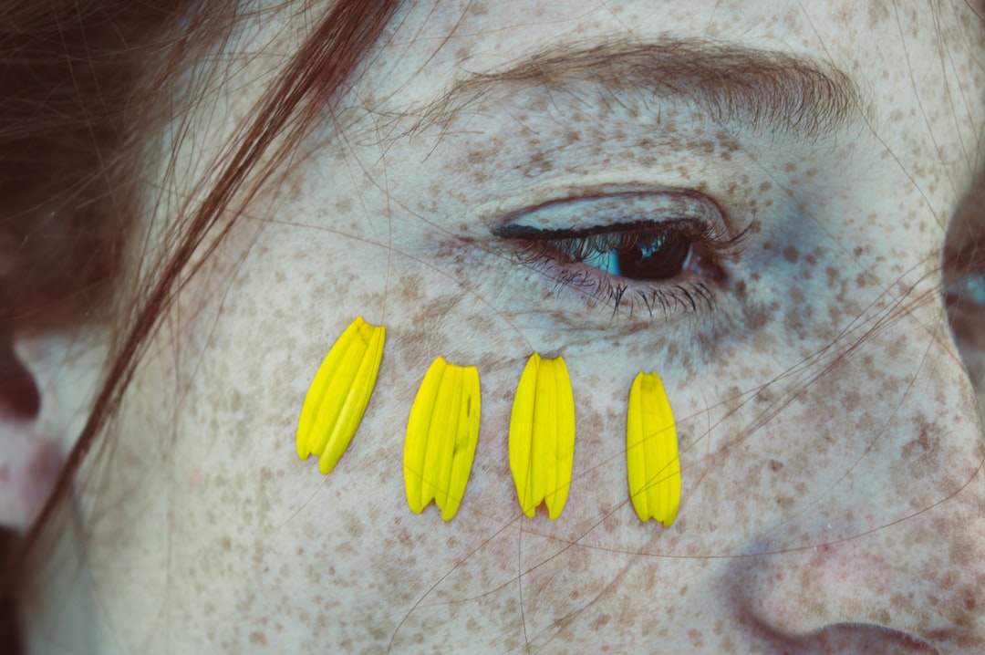 Atopic dermatitis