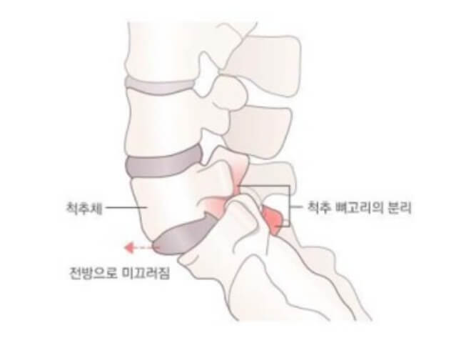척추 전방전위증