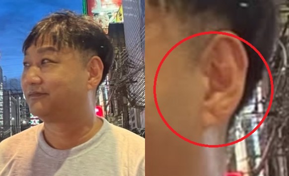 귓볼·귓볼주름(프랑크 징후)과 뇌·심혈관 질환 치매, 뇌졸중 관계, 귓볼(귓볼)주름 없애기, 없애는법