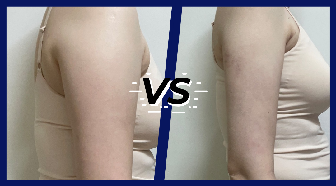 3주차 경과 옆모습 비교 이미지.