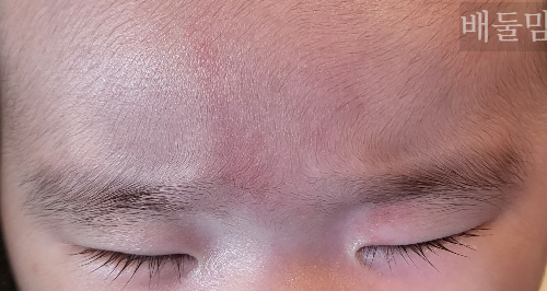 아기 얼굴 연어반 사진.