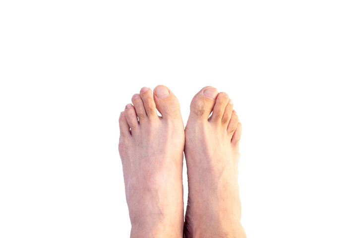 발등이 붓는 이유, 발등이 부어오르는 이유 알아보기