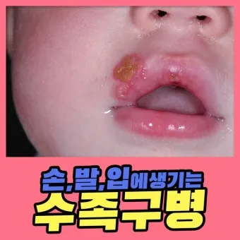 수족구병 증상과 예방 조치 방법 모음_8