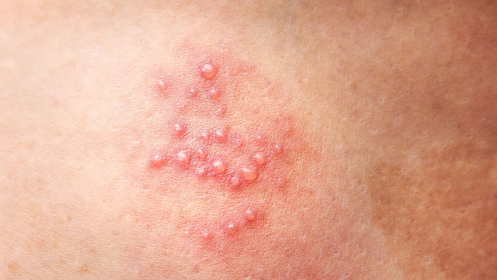 대상포진의 원인