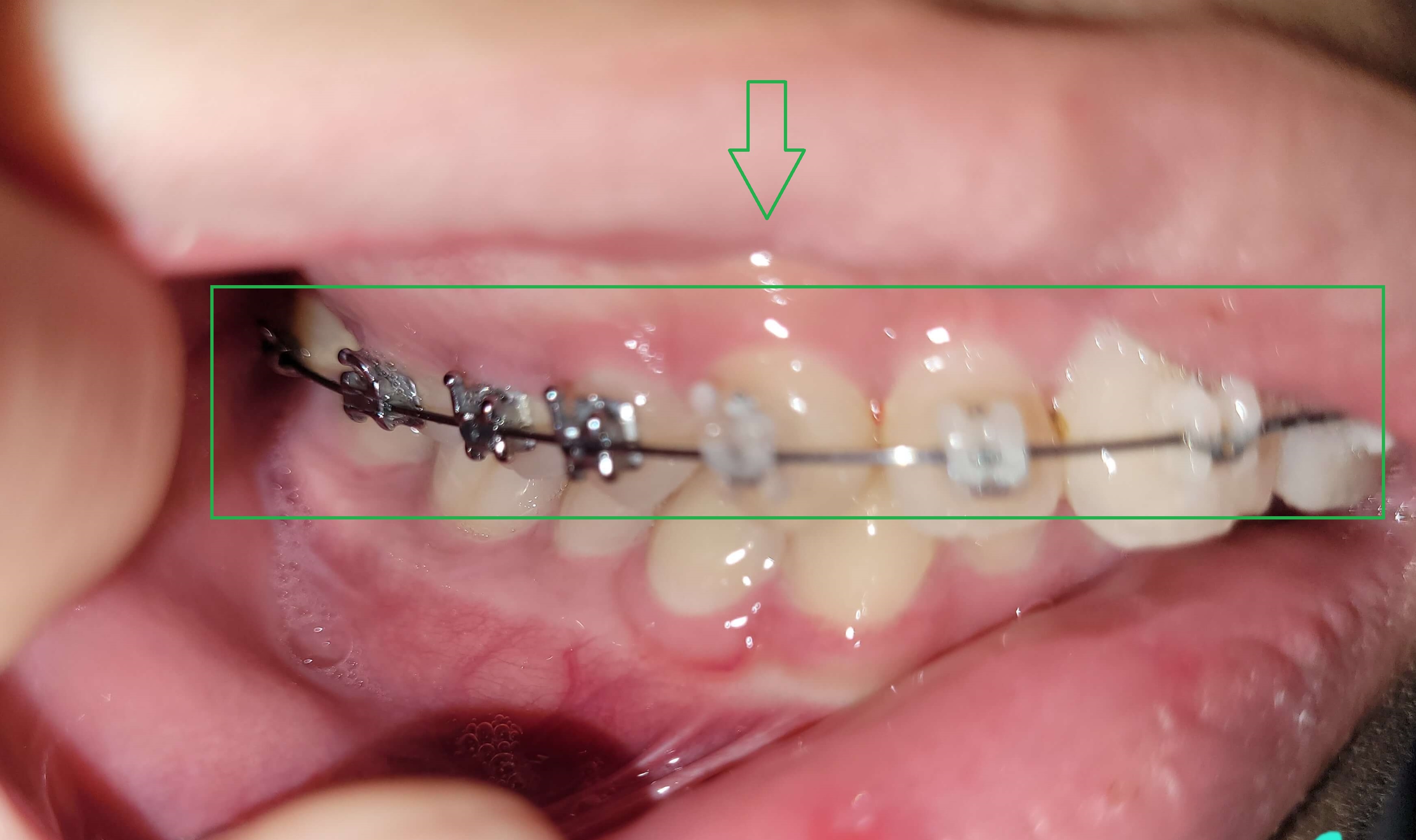 부정교합 가위교합 과개교합 치아교정 후기23