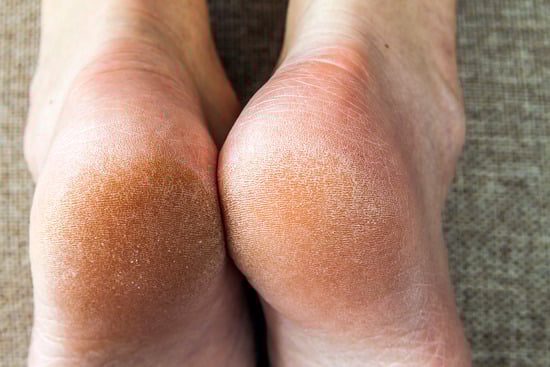 발의 굳은 살 관리 방법