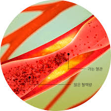 고혈압 낮추는 방법 10가지