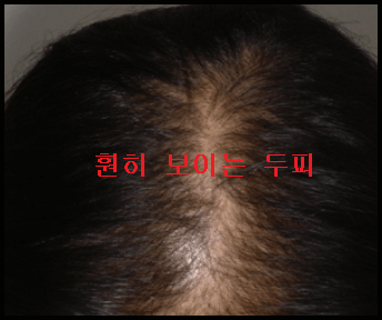 두피가 훤히 보이는 탈모