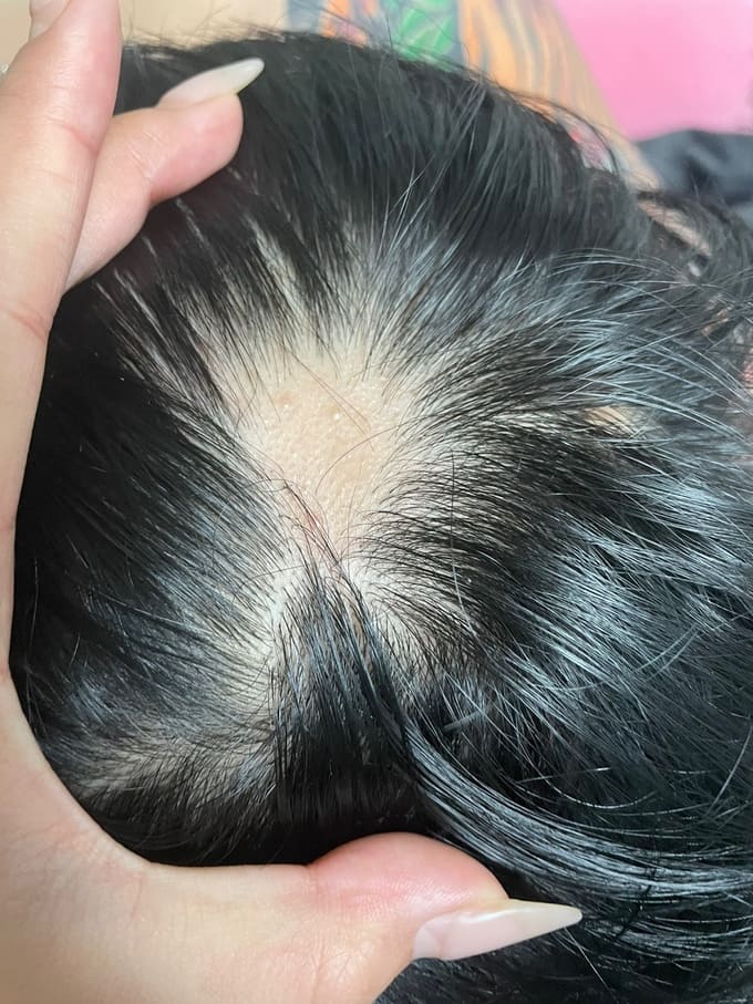 이런 어쩌나!...접종 후 탈모, 직장도 그만두고 여친과도 이별...우울증 심해져