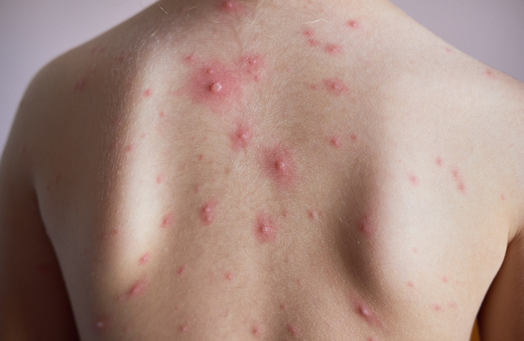 chickenpox symptom 3