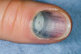 손톱 색깔로 보는 건강