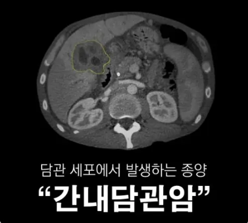 담관세포암