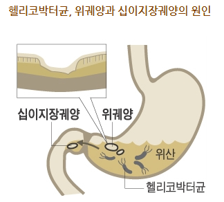헬리코박터 제균 치료와 골다공증 예방의 관계 관련 이미지