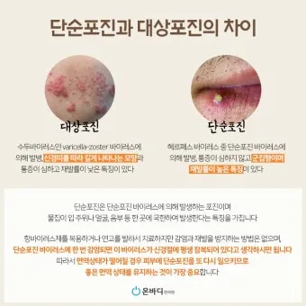대상포진 치료방법에 대한 총정리 건강 질병관리_3
