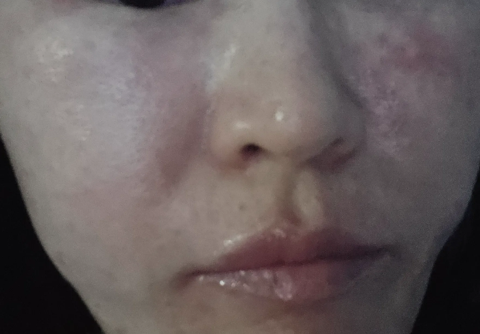 코 주변 나비존과 양 볼 전체가 심하게 붉어지고 피부 표면이 거칠고 오돌도돌하게 뒤집어진 주사피부염 증상 격화기 사진