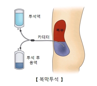 복막투석-사진