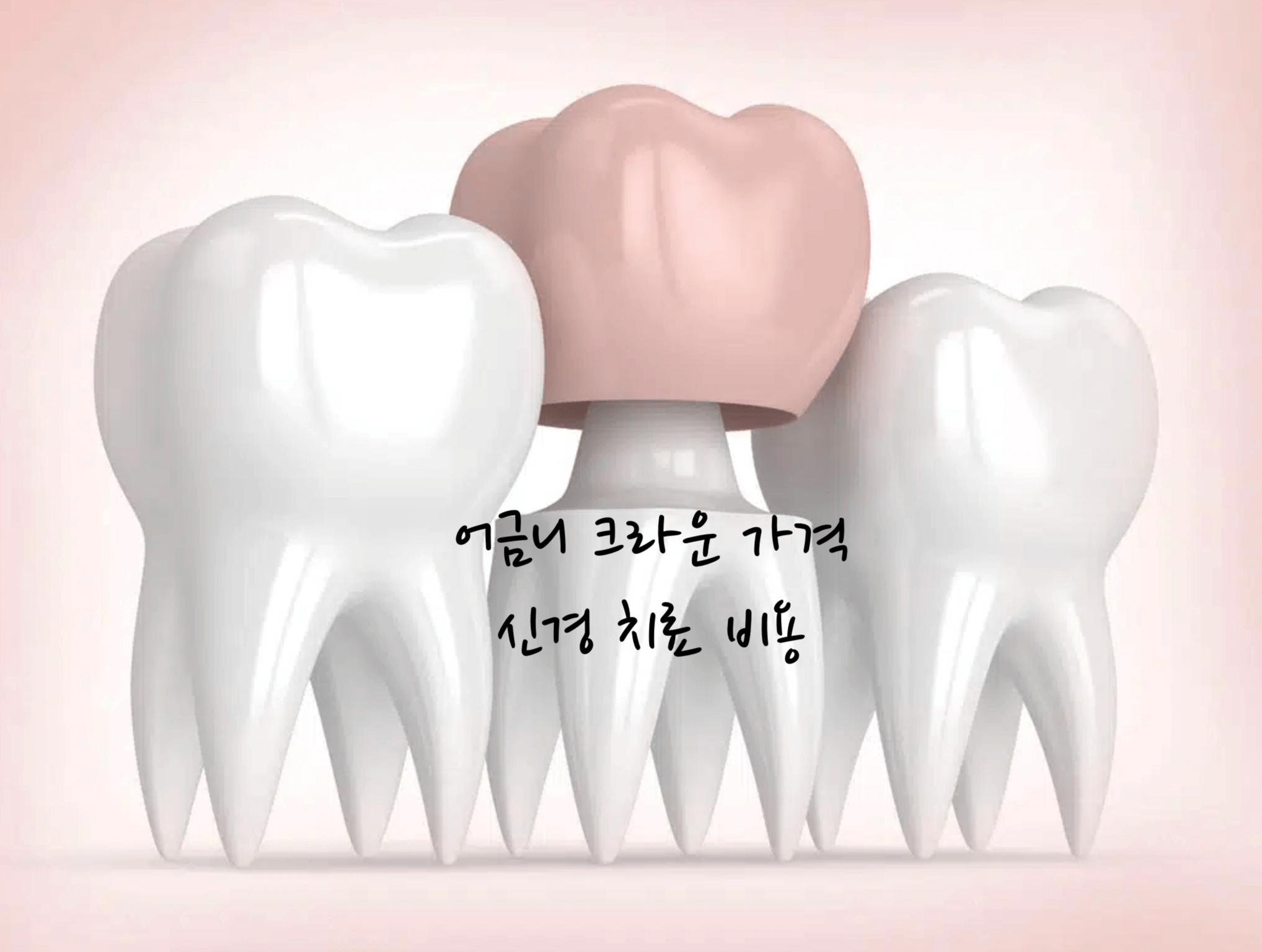 어금니 크라운 종류