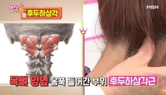 후두하삼각근