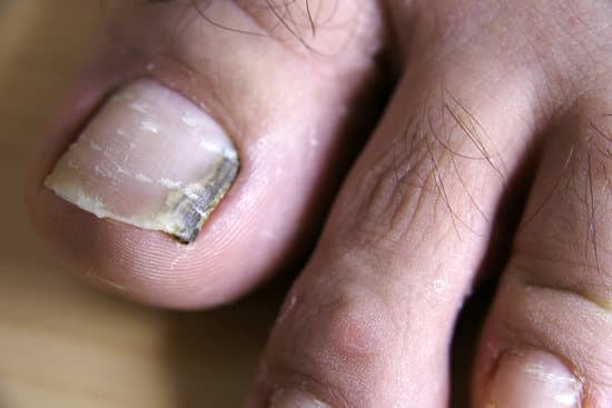 발톱 무좀의 관리와 치료