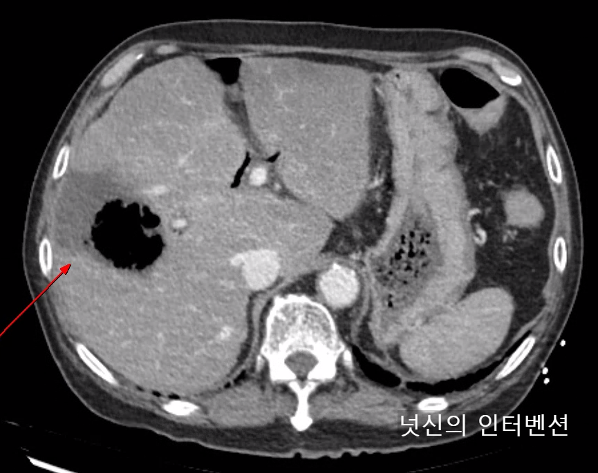 간이 썩는 질환인 간 농양(Hepatic abscess). 혐기성 세균이 생성한 gas 때문에 air cavity 가 보인다. 경피적 배액술로 치료한다.