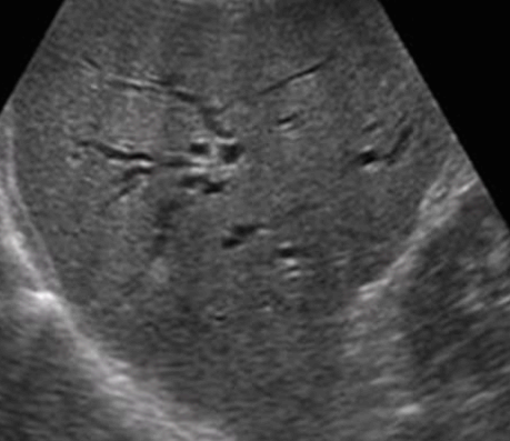 intrahepatic duct measurement(right)
