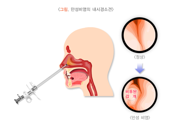 환절기 비염 예방법