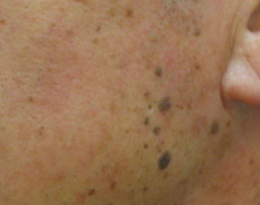 검버섯-없애는-방법-검버섯제거크림