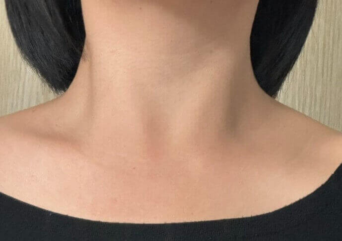 쥐젖 레이저 치료 후 상태