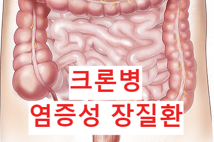 크론병-염증성장질환