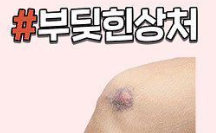 상처별 응급처치 방법