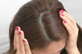 두피 케어 소홀