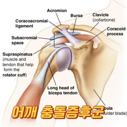 어깨 충돌증후군