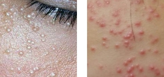 비립종과 좁쌀 여드름 비교