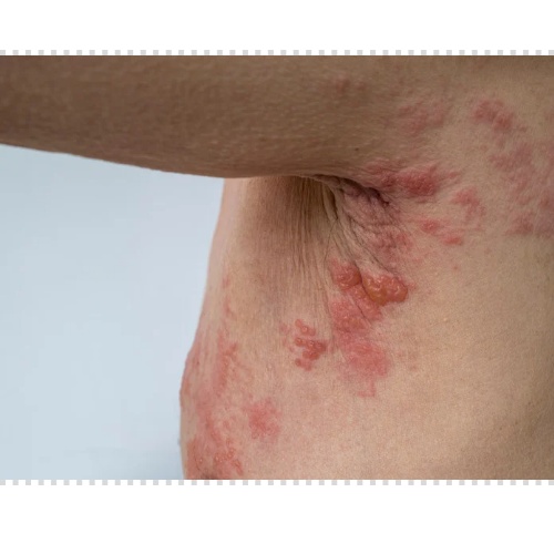 귀 대상포진 증상 후유증