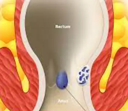 치질-증상-자가치료법-건강