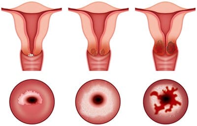 자궁경부암&amp;#44; 자궁경부암 증상&amp;#44; 자궁경부암 예방접종&amp;#44; 자궁경부암 예방접종 무료대상&amp;#44; 자궁경부암 검사&amp;#44; 자궁경부암 원인&amp;#44; 자궁경부암 검사방법&amp;#44; 자궁경부암 예방접종 가격&amp;#44; 자궁경부암 검사 성경험 없는 사람&amp;#44; 자궁경부암 검사비용&amp;#44; 가다실 9가&amp;#44; 서바릭스&amp;#44; 가다실 4가