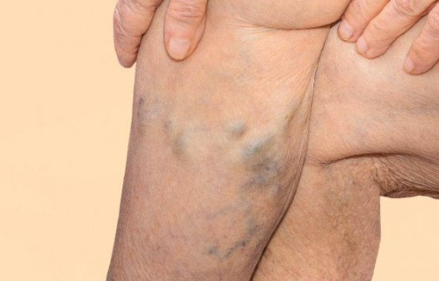 하지정맥류 수술비용과 치료 증상 잘하는 병원 추천