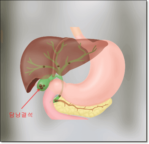 담낭결석으로 인한 담낭염