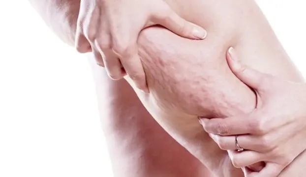 셀룰라이트 없애는 법 5가지