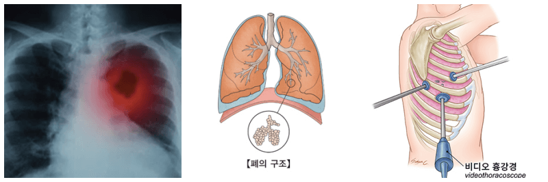 흉부 엑스레이, 폐결절, 비디오 흉강경 수술 사진