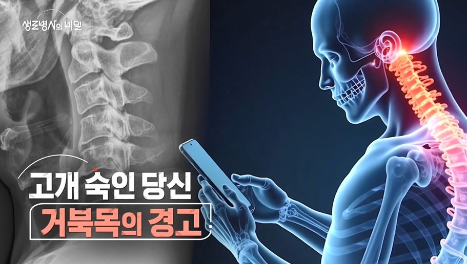 생로병사의 비밀961회/ 고개숙인 당신, 거북목의 경고