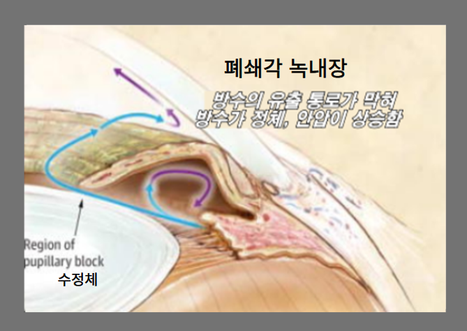 폐쇄각 녹내장 증상