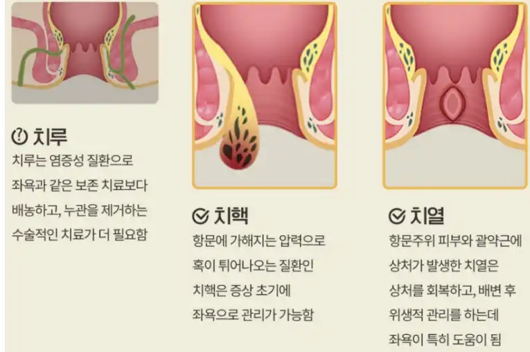 치열